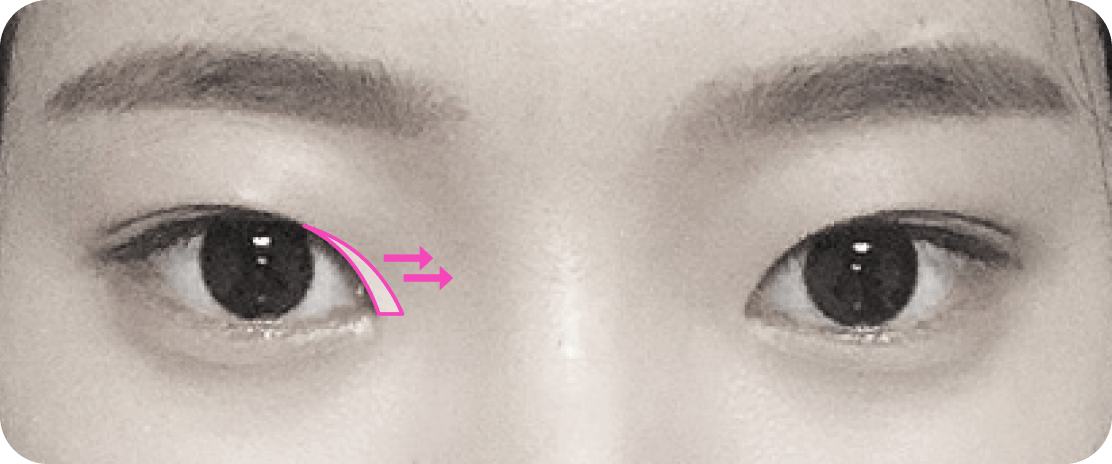 id Hospital - Canthoplasty - Epicanthoplasty Before