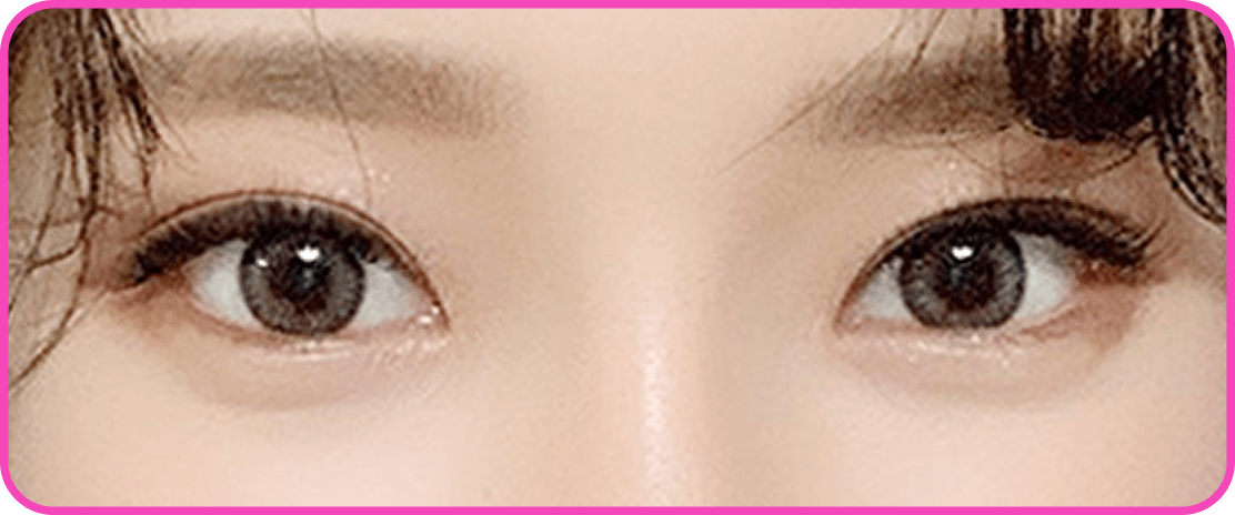 id Hospital - Canthoplasty - Epicanthoplasty After