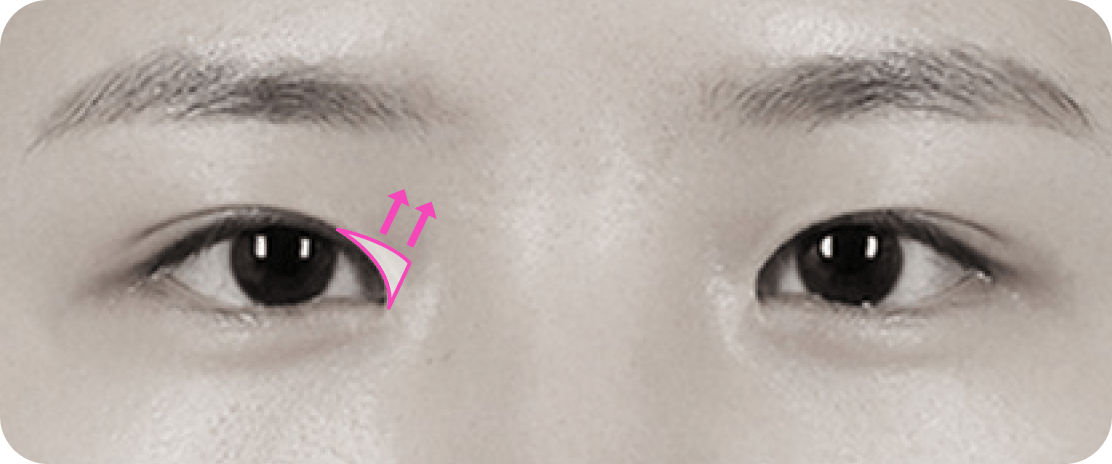 id Hospital - Canthoplasty - 45-degree Canthoplasty Before