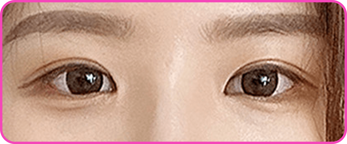 id Hospital - Canthoplasty - 45-degree Canthoplasty After