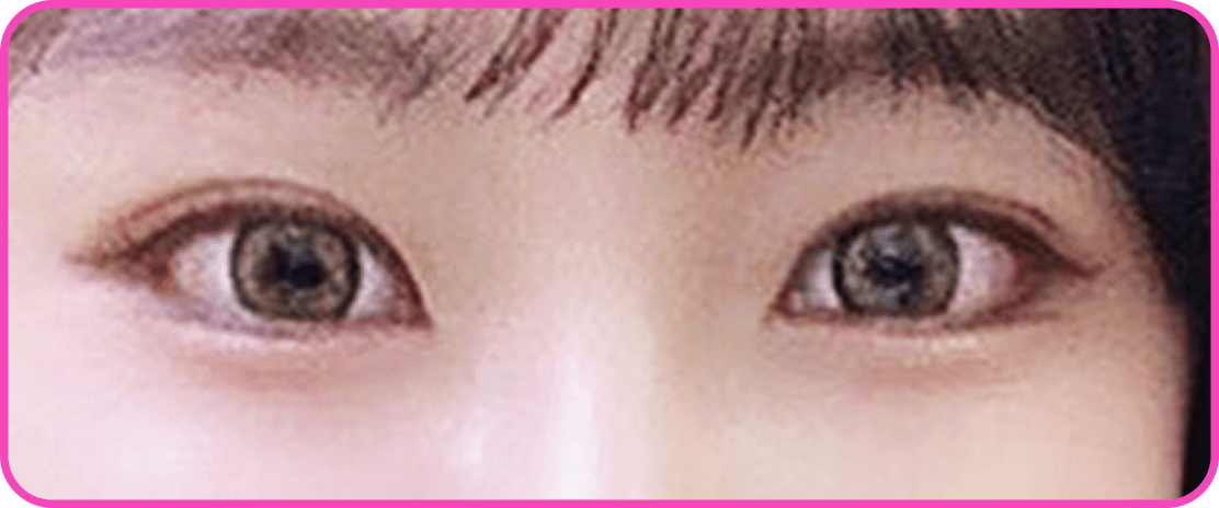 id Hospital - Canthoplasty - Lateral Canthoplasty After