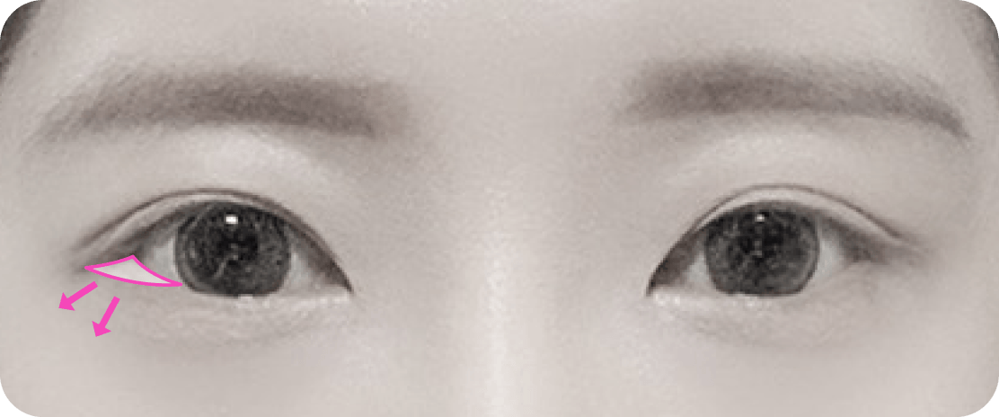 id Hospital - Canthoplasty - Lateral Hotz Canthoplasty Before