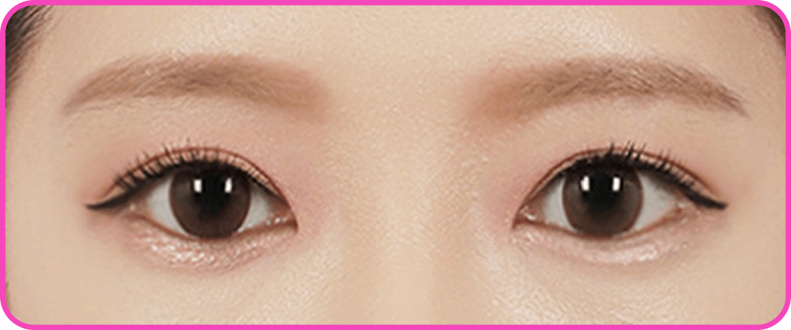 id Hospital - Canthoplasty - Lateral Hotz Canthoplasty After