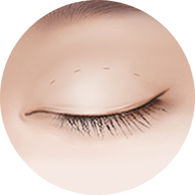 id Hospital - Double Eyelid Surgery - Double Lock Buried Method Diagram