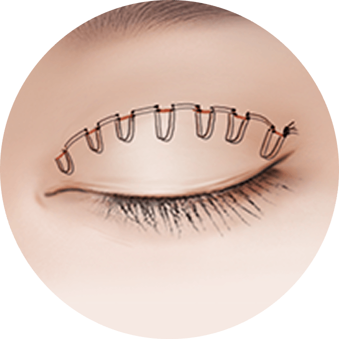 id Hospital - Double Eyelid Surgery - Double Lock Buried Method Diagram