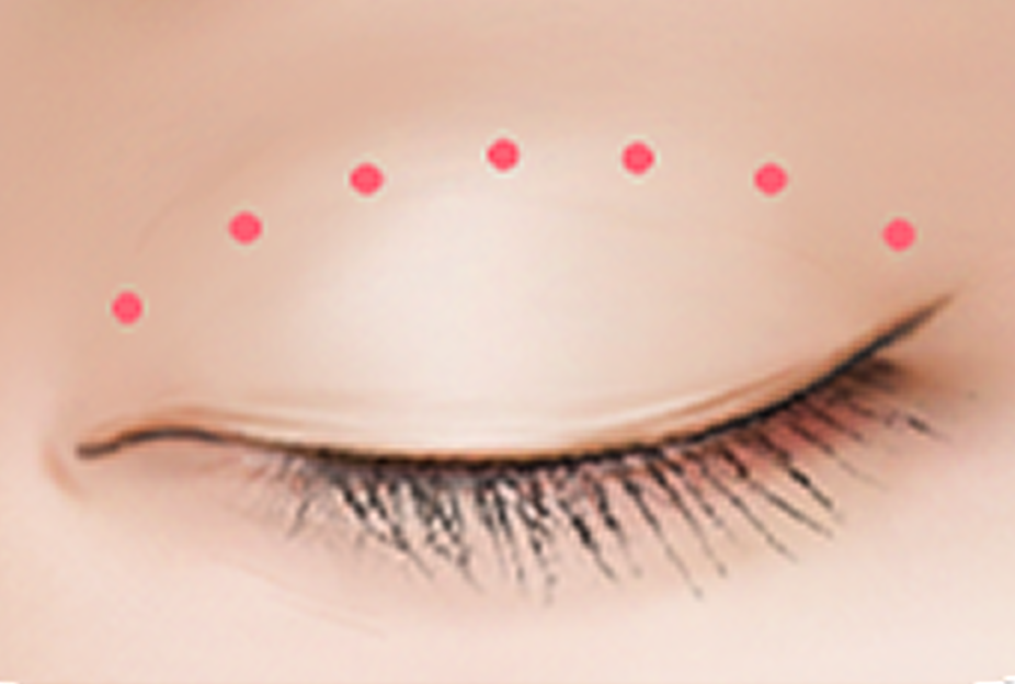 id Hospital - Double Eyelid Surgery - Design Step