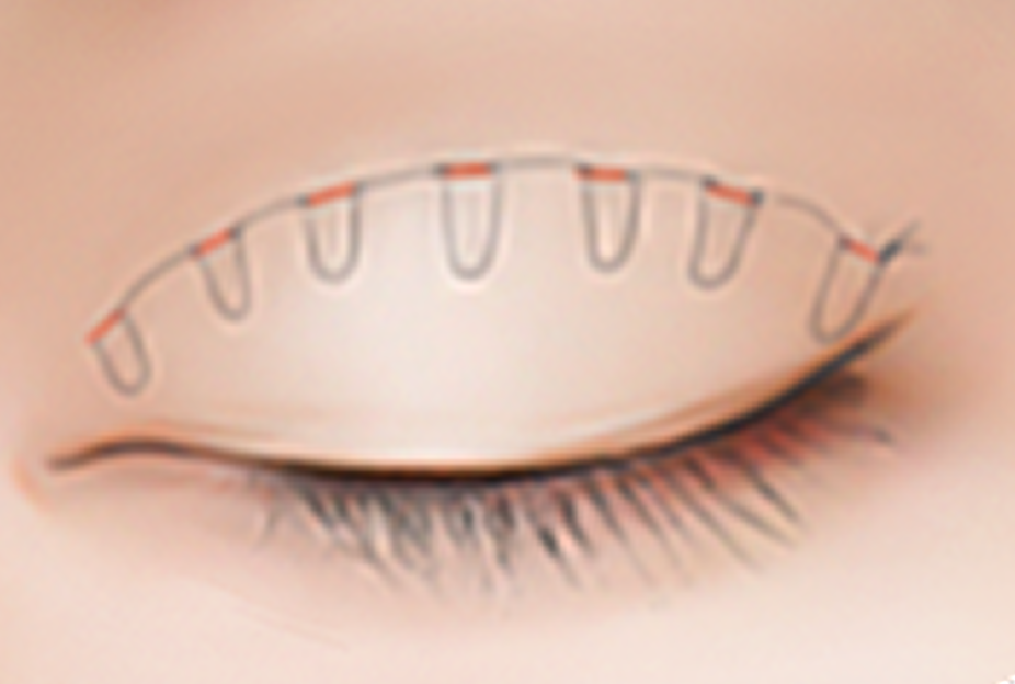 id Hospital - Double Eyelid Surgery - Suture Fixation Step