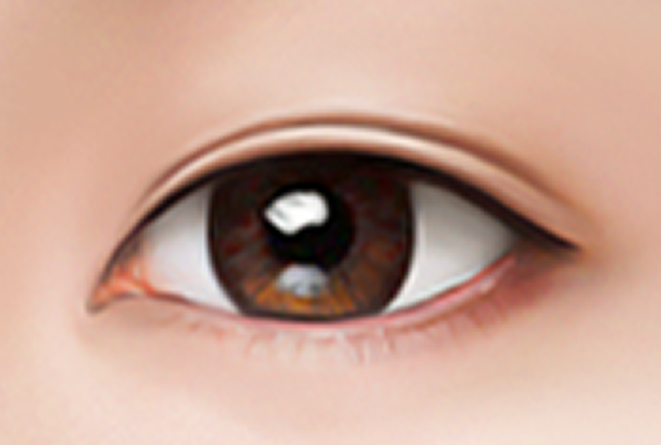 id Hospital - Double Eyelid Surgery - Result After Surgery