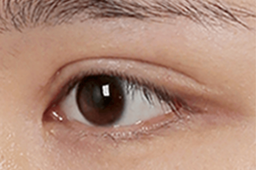 id Hospital - Double Eyelid Surgery - Fat Not Properly Removed