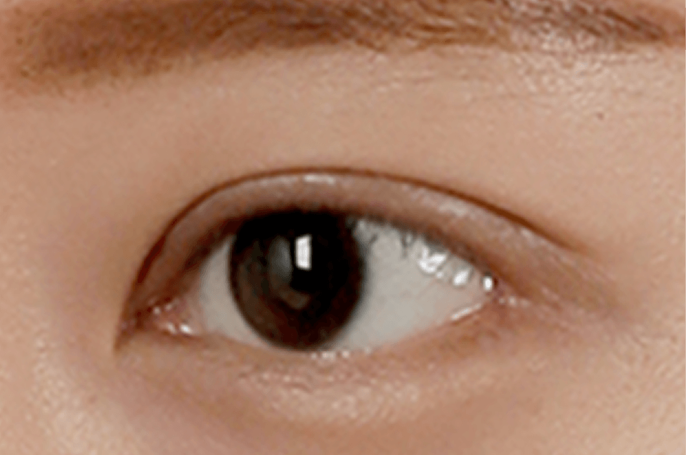 id Hospital - Double Eyelid Surgery - Fat Properly Removed