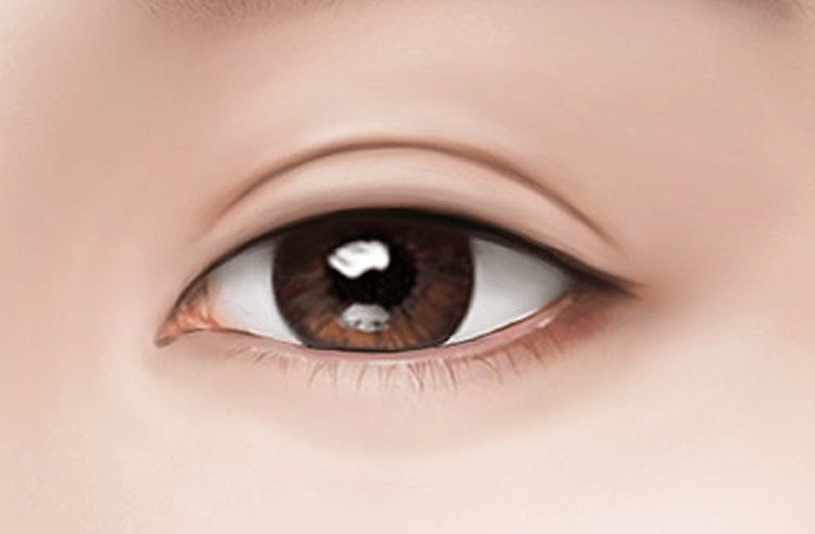 id Hospital - Double Eyelid Incisional Method - Traditional Incision Method