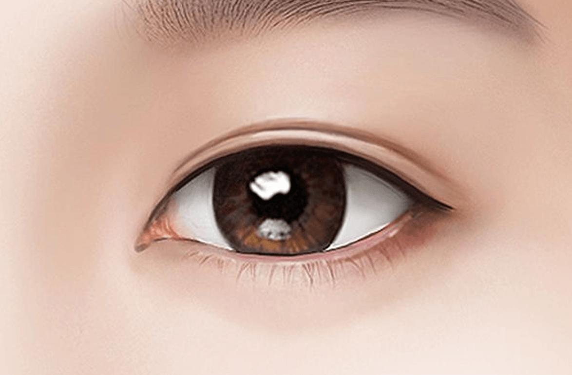 id Hospital - Double Eyelid Incisional Method - Skinny Incision Method