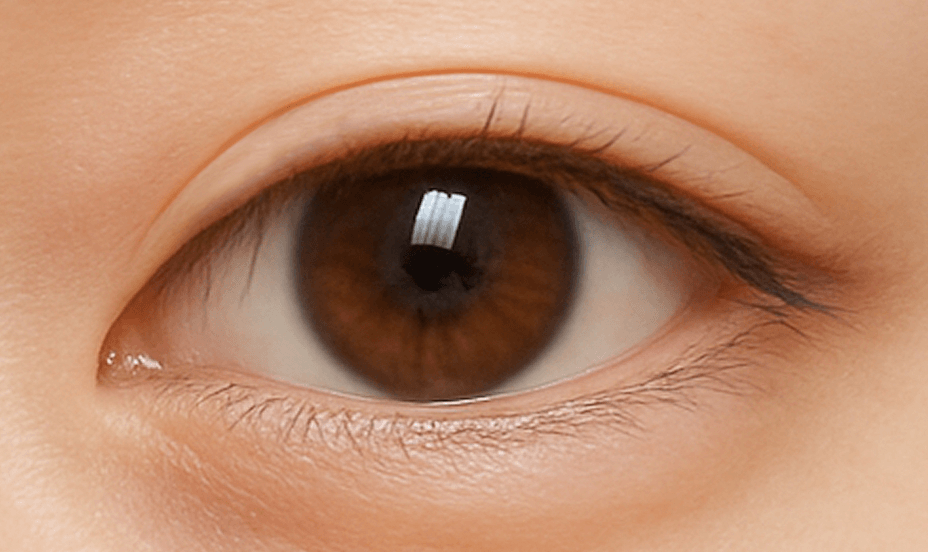 id Hospital - Double Thread Non-Incision Method - Natural and Prominent Double Eyelids