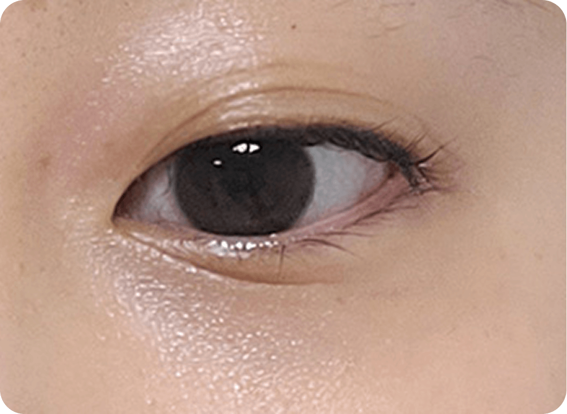 id Hospital - Ptosis Correction - Droopy Eyes Before