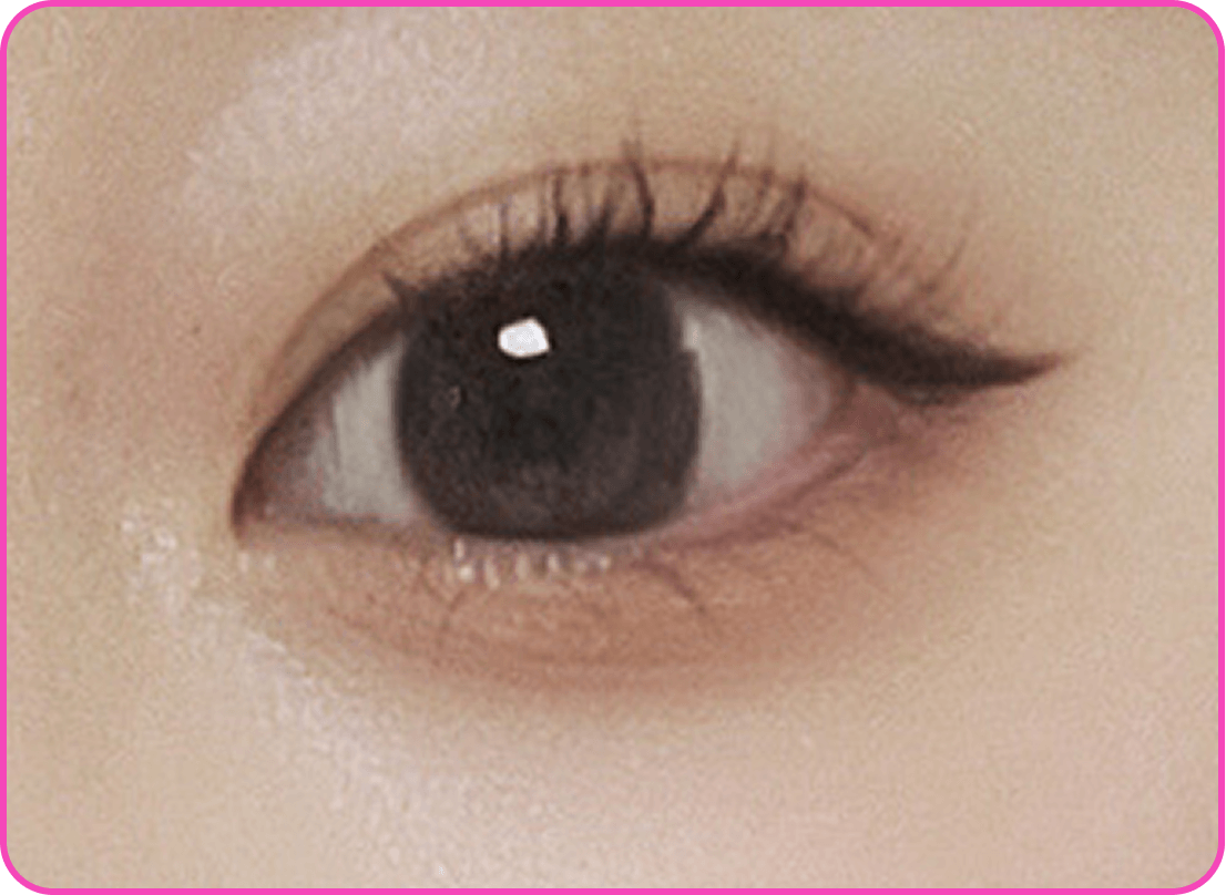 id Hospital - Ptosis Correction - Droopy Eyes After