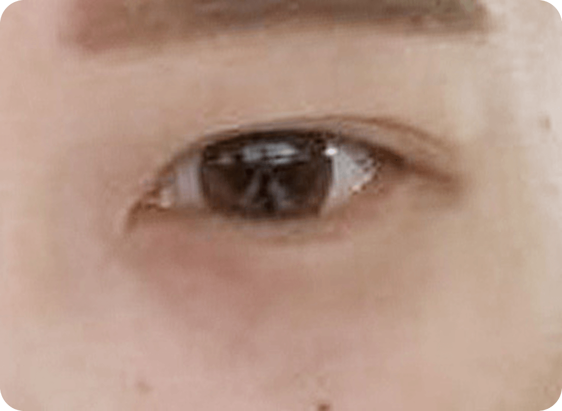 id Hospital - Ptosis Correction - Sleepy Eyes Before