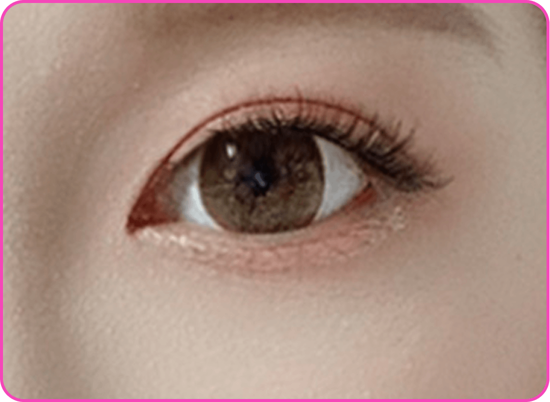 id Hospital - Ptosis Correction - Sleepy Eyes After