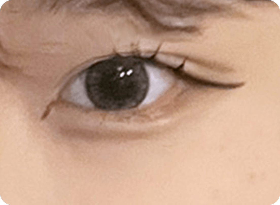 id Hospital - Ptosis Correction - Small Eyes Before