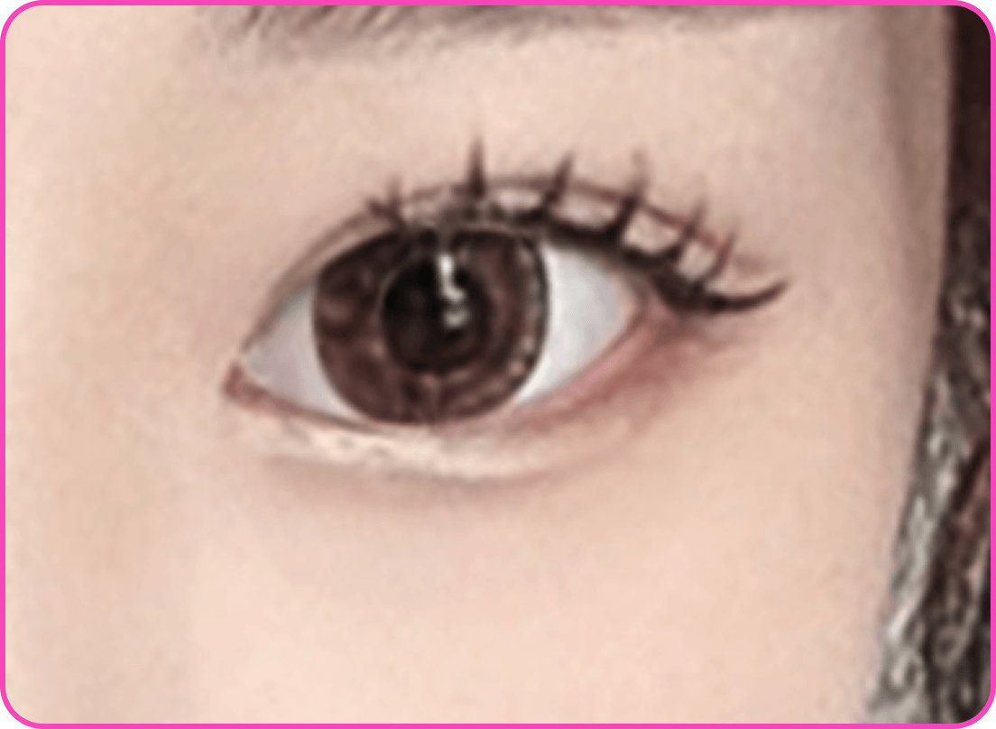 id Hospital - Ptosis Correction - Small Eyes After