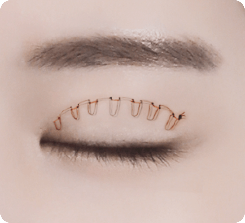 id Hospital - Ptosis Correction - Surgical Anatomy Diagram