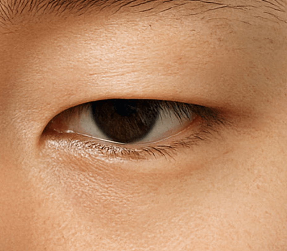 id Hospital - Ptosis Correction - Non-Incisional Method Step 1