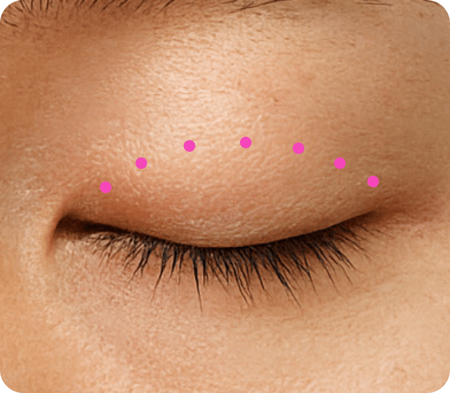 id Hospital - Ptosis Correction - Non-Incisional Method Step 2