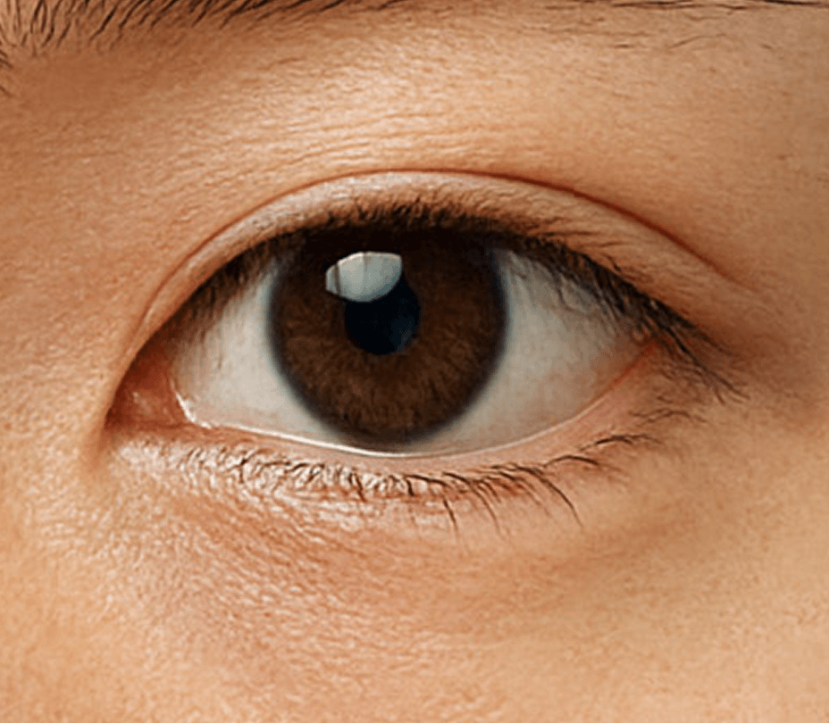 id Hospital - Ptosis Correction - Non-Incisional Method Step 3