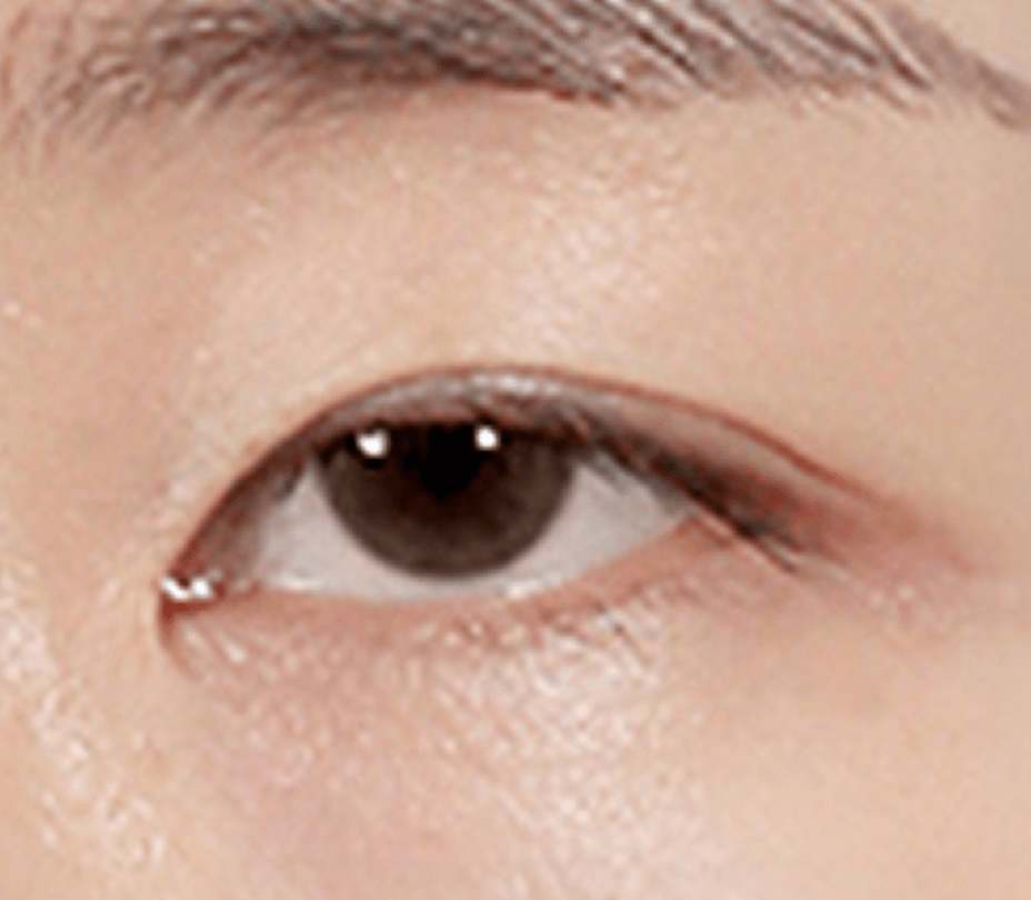 id Hospital - Ptosis Correction - Control Ptosis Correction Step 1