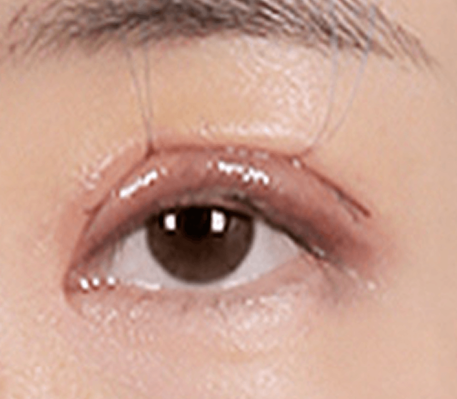 id Hospital - Ptosis Correction - Control Ptosis Correction Step 2