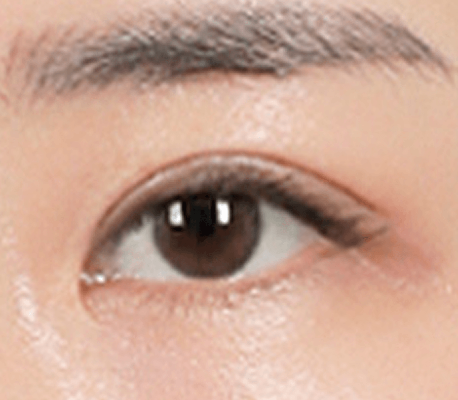 id Hospital - Ptosis Correction - Control Ptosis Correction Step 3