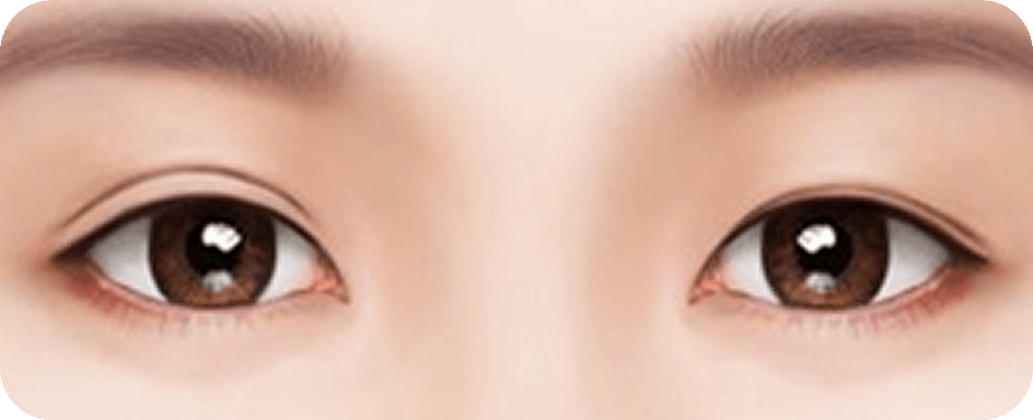 id Hospital - Revision Eyelid Surgery - Asymmetrical double eyelid lines