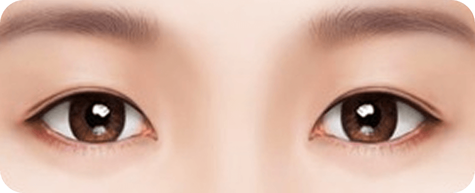 id Hospital - Revision Eyelid Surgery - Low double eyelid lines