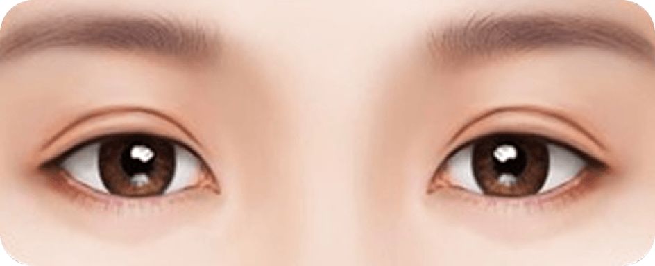 id Hospital - Revision Eyelid Surgery - Thick puffy double eyelids
