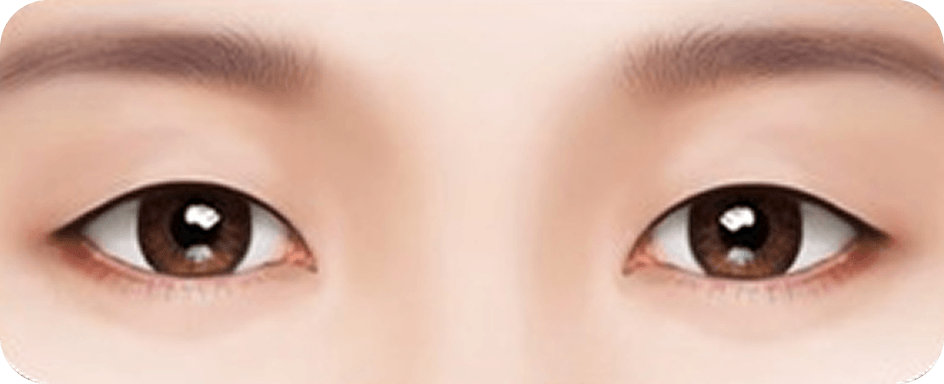 id Hospital - Revision Eyelid Surgery - Loosened double eyelids