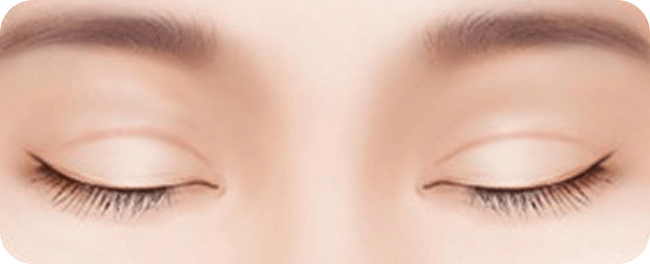 id Hospital - Revision Eyelid Surgery - Prominent scarred lines
