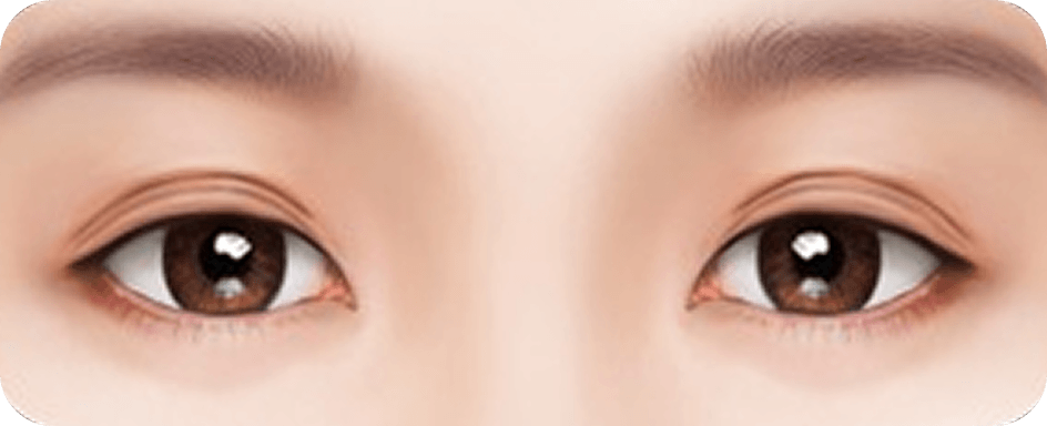id Hospital - Revision Eyelid Surgery - Multiple overlapping eyelid folds
