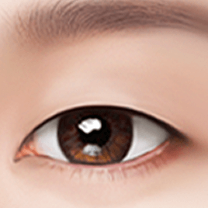 id Hospital - Revision Eyelid Surgery - Non-Incisional Method Step 1