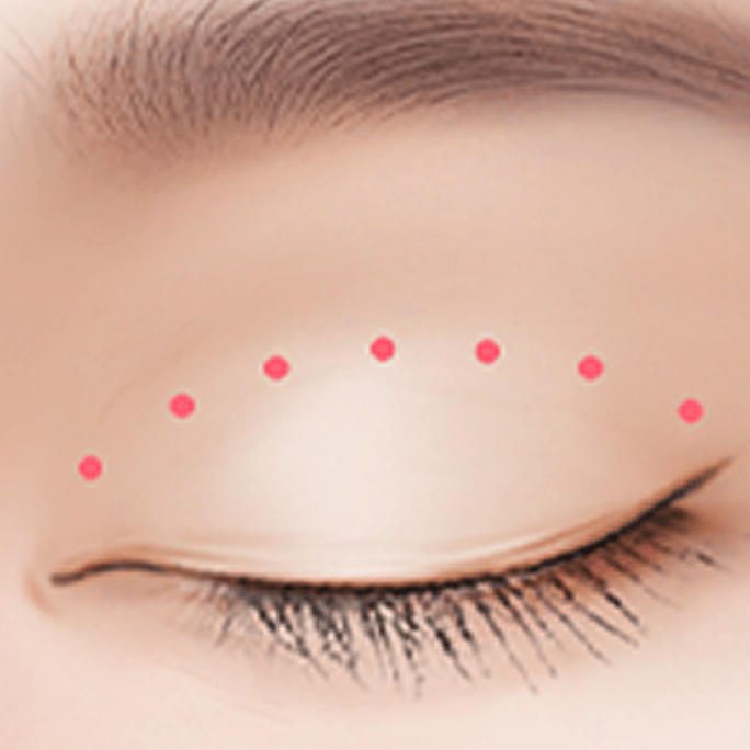 id Hospital - Revision Eyelid Surgery - Non-Incisional Method Step 2