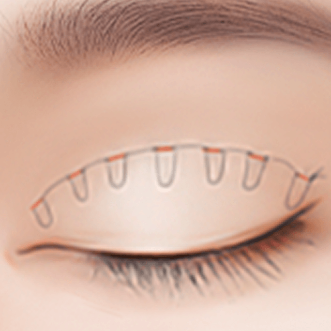 id Hospital - Revision Eyelid Surgery - Non-Incisional Method Step 3