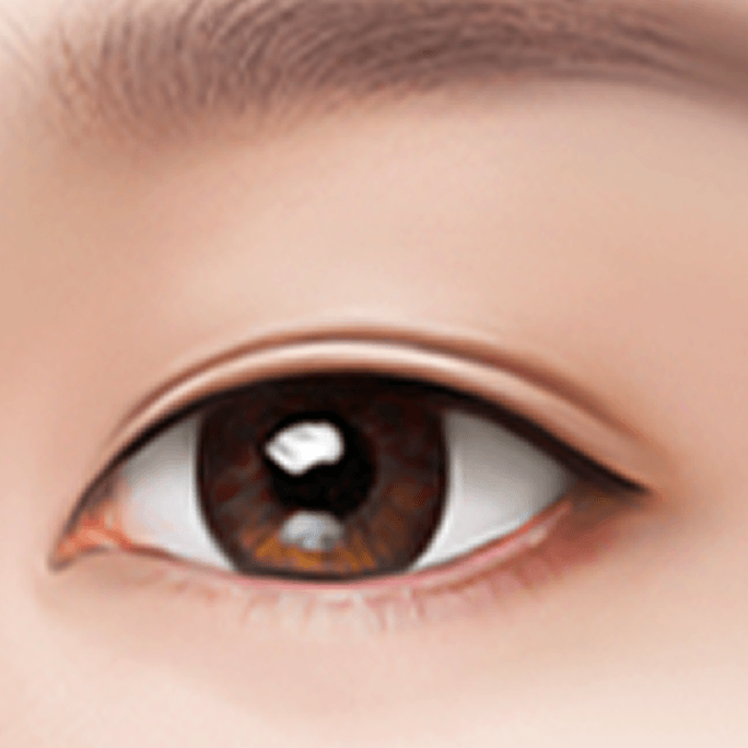 id Hospital - Revision Eyelid Surgery - Non-Incisional Method Step 4