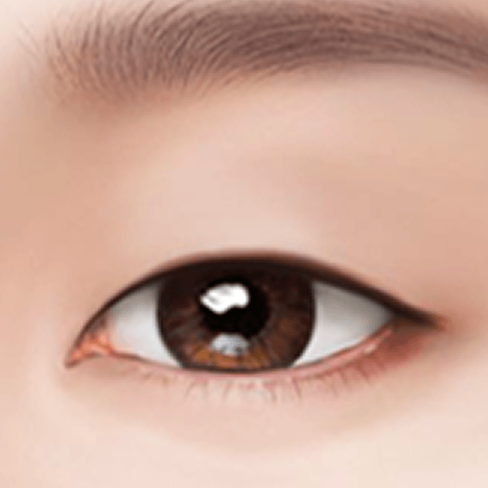 id Hospital - Revision Eyelid Surgery - Incisional Method Step 1