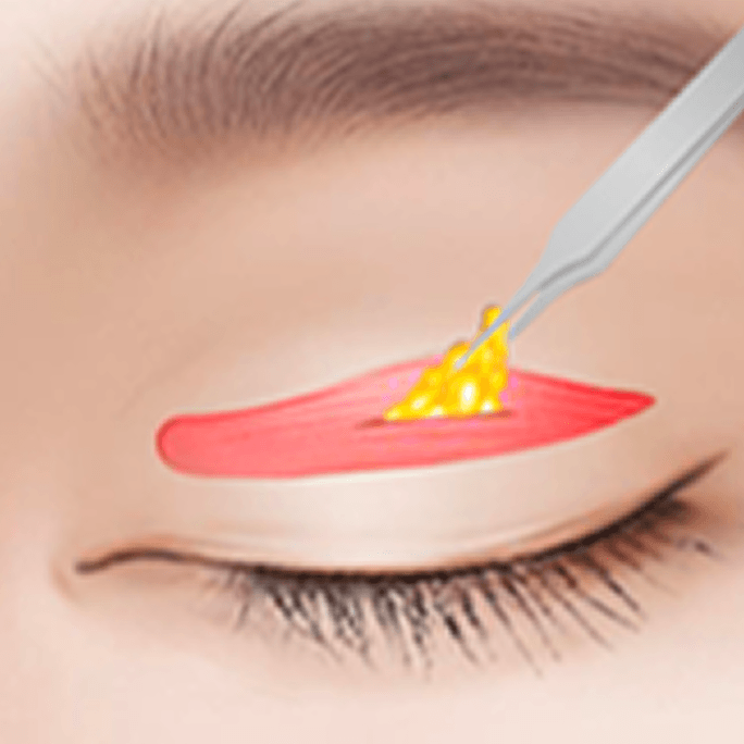 id Hospital - Revision Eyelid Surgery - Incisional Method Step 2