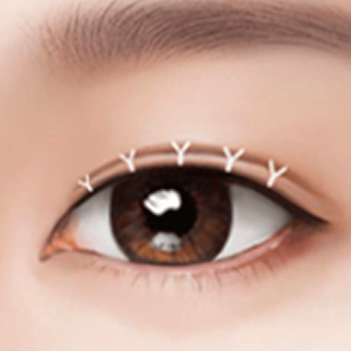 id Hospital - Revision Eyelid Surgery - Incisional Method Step 3