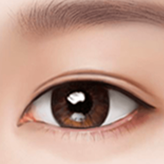 id Hospital - Revision Eyelid Surgery - Incisional Method Step 4