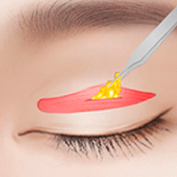 id Hospital - Revision Eyelid Surgery - Two-Line Revision Step 2