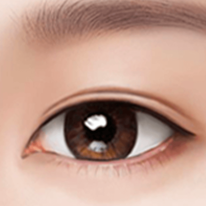 id Hospital - Revision Eyelid Surgery - Two-Line Revision Step 4