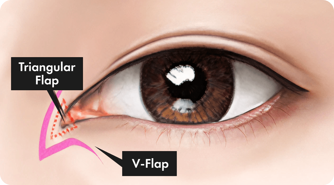 id Hospital - Revision Eyelid Surgery - Epicanthoplasty Revision Step 1