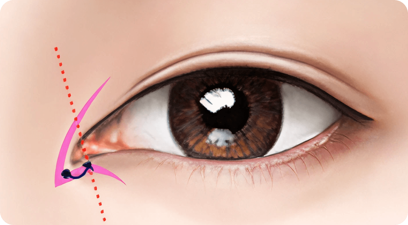 id Hospital - Revision Eyelid Surgery - Epicanthoplasty Revision Step 2
