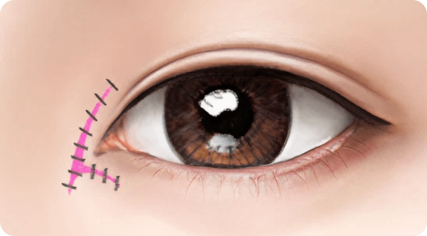 id Hospital - Revision Eyelid Surgery - Epicanthoplasty Revision Step 3
