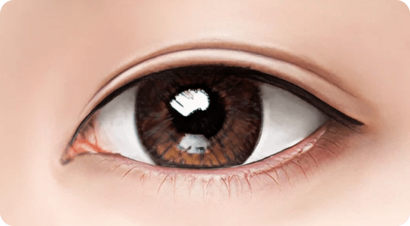 id Hospital - Revision Eyelid Surgery - Epicanthoplasty Revision Step 4